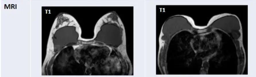 Хөхний имплант хагарах: заавал MRI хийлгэх ёстой юу? Хэт авиан шинжилгээгээр шалгаж болохгүй гэж үү — нийтлэлийн зураг 6