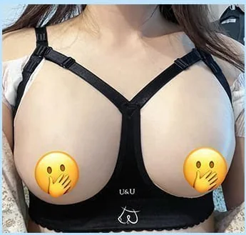 Хөхний мэс заслын 2 дахь өдөр, засварын лифчик өмссөн урд талын зураг 1