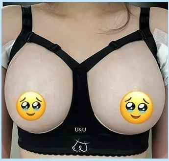 Хөхний мэс заслын 2 дахь өдөр, засварын лифчик өмссөн урд талын зураг 2