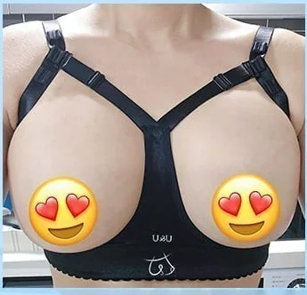 Хөхний мэс заслын 2 дахь өдөр, засварын лифчик өмссөн урд талын зураг 6