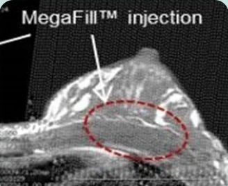 MegaFill™ injection — хөхний хажуу талын CT дүрс дээр суулгасан хэсгийг тэмдэглэсэн зураг