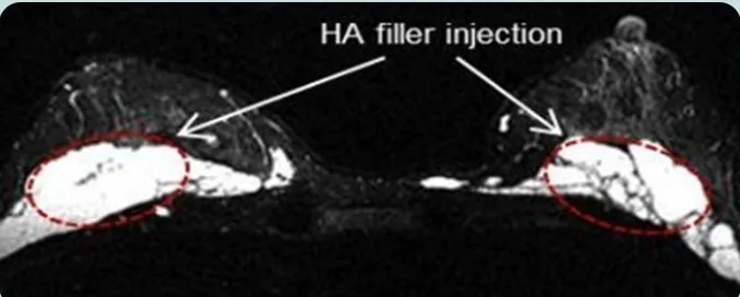 HA filler injection — хоёр хөхний MRI хөндлөн зүсэлтийн дүрс дээр филлер тарьсан хэсгийг тэмдэглэсэн зураг