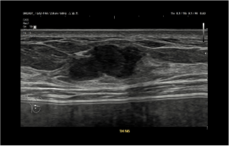 Healthy Breast Хөхний хорт хавдрын хэт авиан img10 m