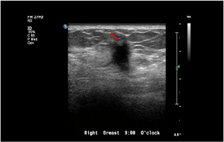Healthy Breast Хөхний хорт хавдрын хэт авиан img11 m