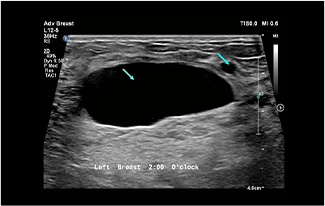 Healthy Breast Хөхний хорт хавдрын хэт авиан img12 m