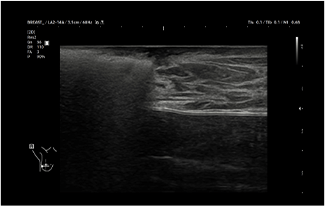 Healthy Breast Хөхний хорт хавдрын хэт авиан img14 m