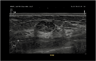 Healthy Breast Хөхний хорт хавдрын хэт авиан img9 m