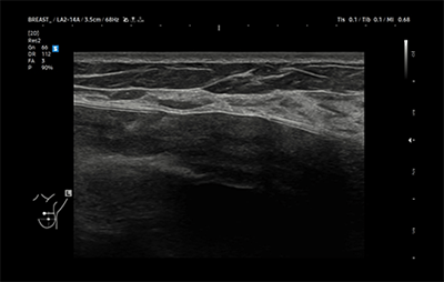 healthy breast Имплантын хэт авиан img10