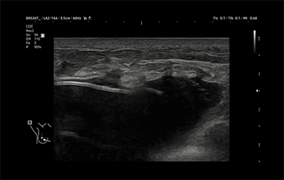 healthy breast Имплантын хэт авиан img8