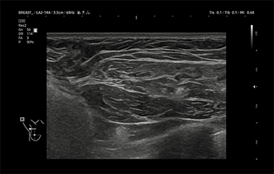 healthy breast Имплантын хэт авиан img9