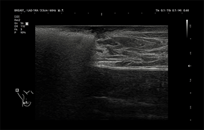 healthy breast Хөхний хорт хавдрын хэт авиан img12