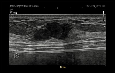 healthy breast Хөхний хорт хавдрын хэт авиан img8
