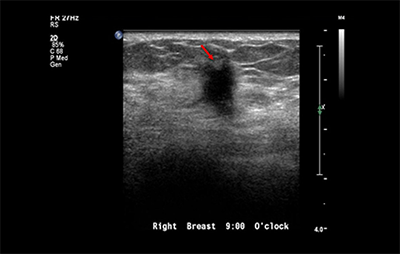 healthy breast Хөхний хорт хавдрын хэт авиан img9